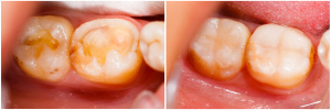Before and After Treatment