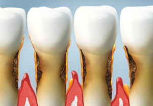 treat your teeth, periodontal